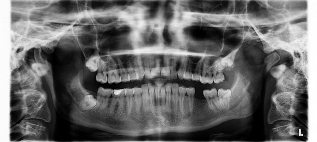 Radiografía de dientes